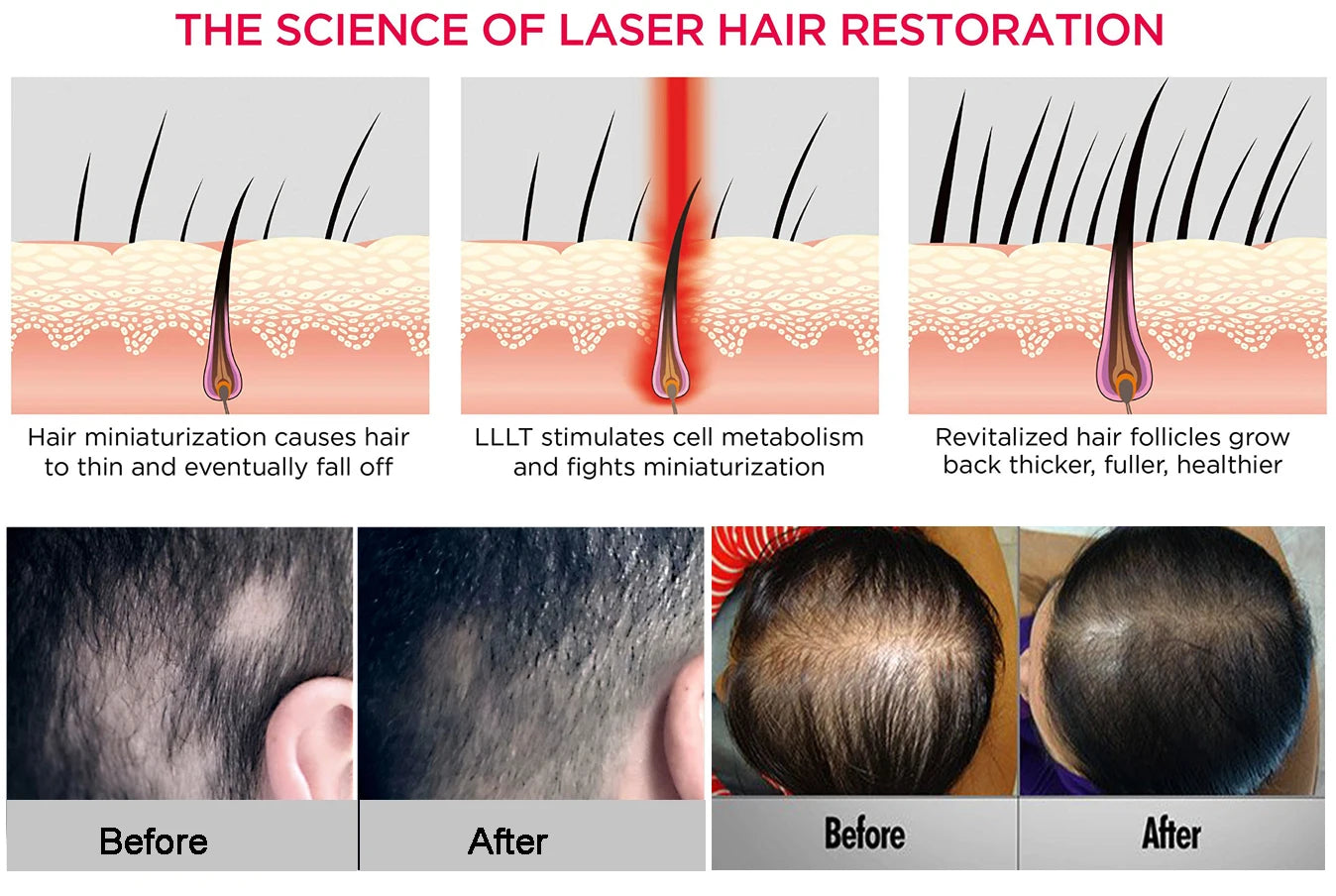 Casque de croissance des cheveux Anti-perte de cheveux Laser chapeau repousse des cheveux dispositif